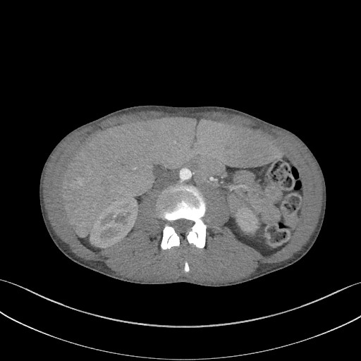 Cannonball metastases - testicular choriocarcinoma (Radiopaedia 84510-99891 B 131).jpg