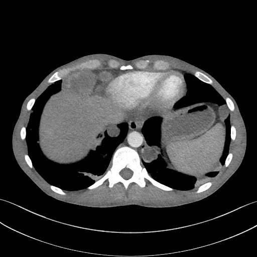 Cannonball metastases - testicular choriocarcinoma (Radiopaedia 84510-99891 B 90).jpg