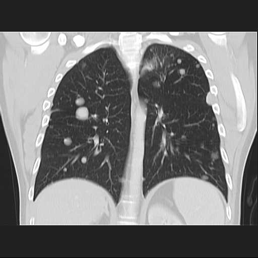 File:Cannonball pulmonary metastases (Radiopaedia 67684-77101 C 16).jpg