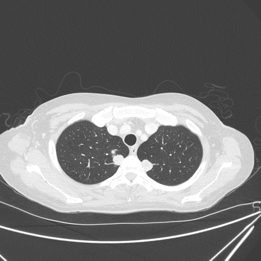 Canonball lung metastasis (Radiopaedia 77634-89837 Axial lung window 34).jpg