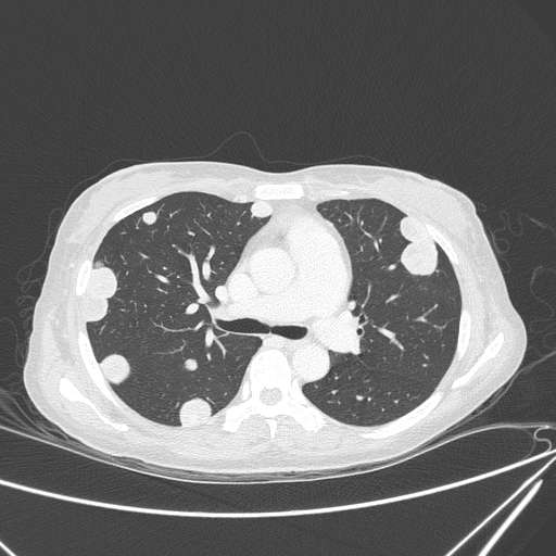 Canonball lung metastasis (Radiopaedia 77634-89837 Axial lung window 76).jpg