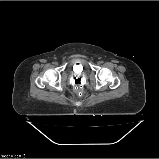 File:Carcinoma cervix- brachytherapy applicator (Radiopaedia 33135-34173 Axial non-contrast 36).jpg