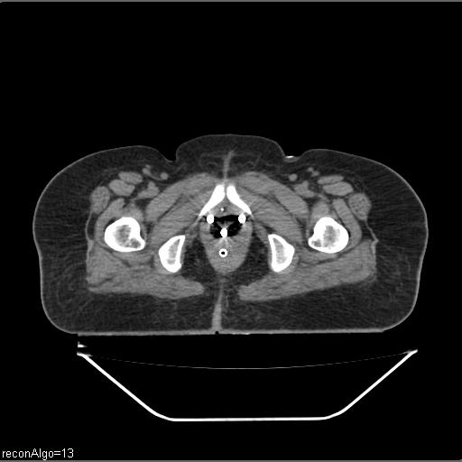 File:Carcinoma cervix- brachytherapy applicator (Radiopaedia 33135-34173 Axial non-contrast 46).jpg