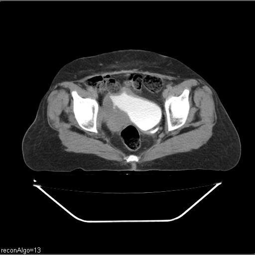 Carcinoma cervix- recurrence (Radiopaedia 34702-36137 B 85).jpg