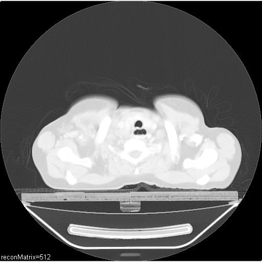 File:Carcinoma of esophagus (Radiopaedia 27356-27550 Axial lung window 31).jpg