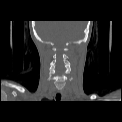Carcinoma of the maxillary antrum (Radiopaedia 53805-59888 Coronal bone window 113).jpg