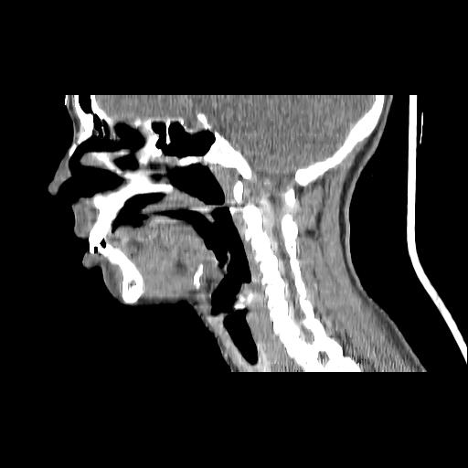Carcinoma of the maxillary antrum (Radiopaedia 53805-59888 Sagittal C+ delayed 100).jpg