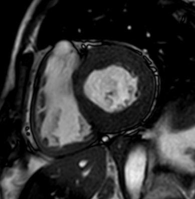 Cardiac amyloidosis - ATTR wild-type (Radiopaedia 74412-85296 short axis cine SSFP 142).jpg