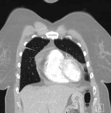Cardiac sarcoidosis (Radiopaedia 74548-85534 Coronal lung window 11).jpg