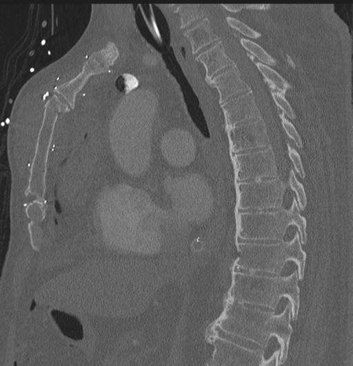 Cardiac trauma (Radiopaedia 32874-33858 Sagittal bone window 46).jpg