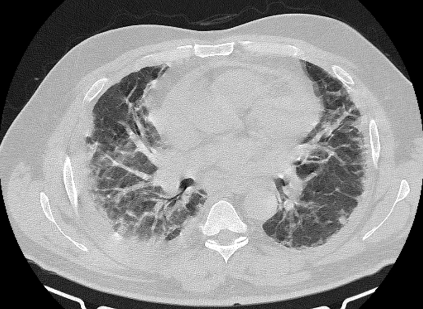 Cardiogenic pulmonary edema (Radiopaedia 68180-77678 Axial lung window 51).jpg