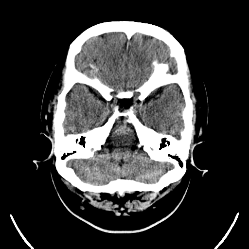 File:Carotico ophthalmic aneurysm (Radiopaedia 42916-46147 Axial non-contrast 4).png