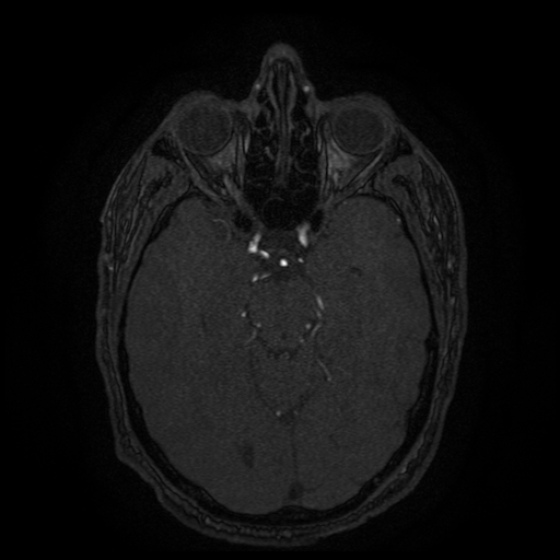 Carotid arterial dissection with acute cerebral infarction (Radiopaedia 26636-26784 MRA 103).jpg