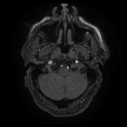 Carotid arterial dissection with acute cerebral infarction (Radiopaedia 26636-26784 MRA 154).jpg