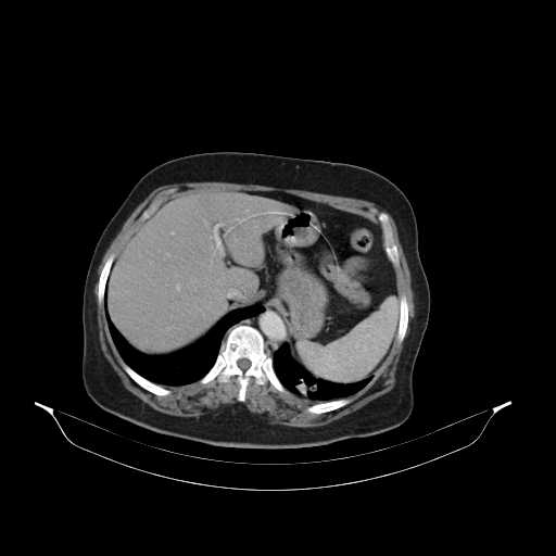 File:Carotid body tumor (Radiopaedia 21021-20948 B 60).jpg