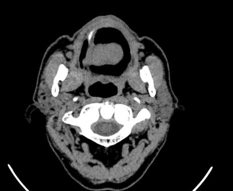Carotid body tumor (Radiopaedia 61750-69757 Axial non-contrast 15).jpg