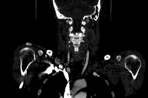 File:Carotid bulb pseudoaneurysm (Radiopaedia 57670-64616 D 45).jpg