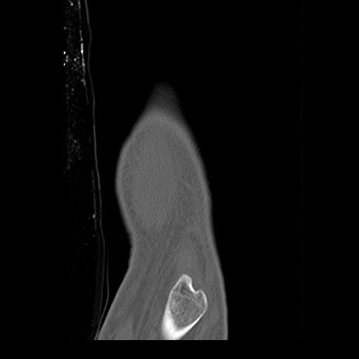 File:Carpo-metacarpal fracture-dislocations with hamatum split fracture (Radiopaedia 18482-18343 Sagittal bone window 1).jpg