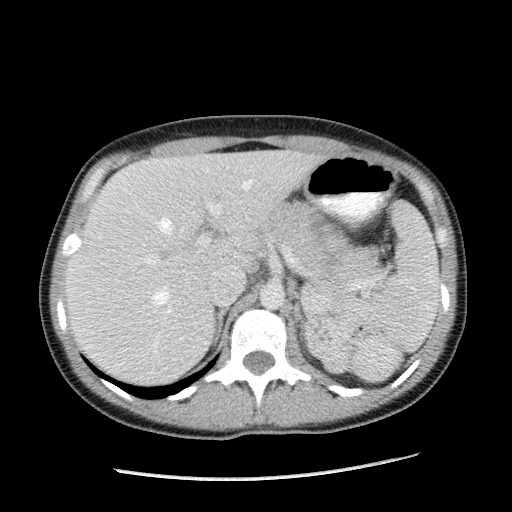 File:Castleman disease with fibrous pseudotumor in the abdomen (Radiopaedia 77296-89373 A 31).jpg