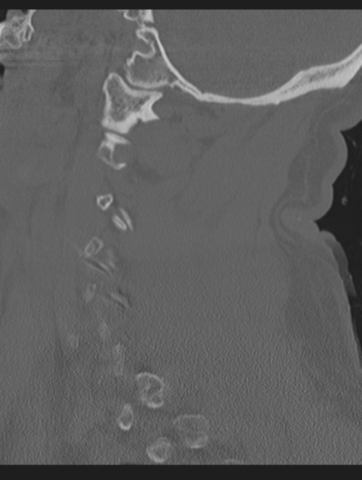 Cavernoma of cervical cord (Radiopaedia 50838-56346 Sagittal bone window 24).png