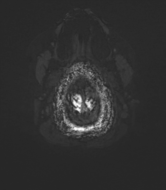 File:Cavernoma with bleed - midbrain (Radiopaedia 54546-60773 Axial SWI 48).png