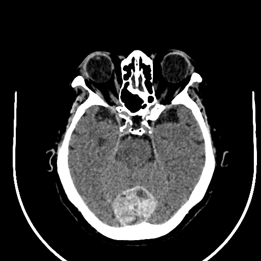 Cavernous hemangioma of the cerebellar falx (Radiopaedia 73025-83723 Axial non-contrast 47).jpg