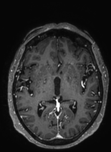 Cavernous hemangioma of the cerebellar falx (Radiopaedia 73025-83724 Axial T1 C+ 171).jpg