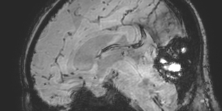 Cavernous hemangioma of the cerebellar falx (Radiopaedia 73025-83724 Sagittal BOLD 105).jpg
