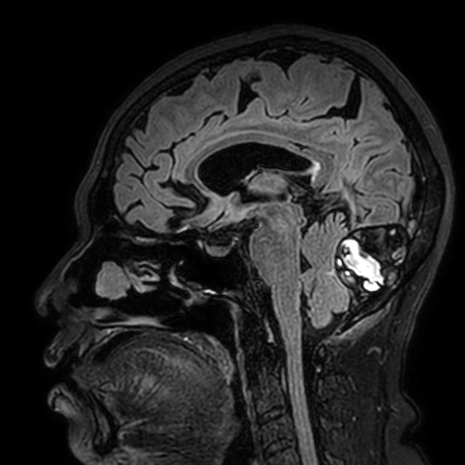Cavernous hemangioma of the cerebellar falx (Radiopaedia 73025-83724 Sagittal FLAIR 101).jpg
