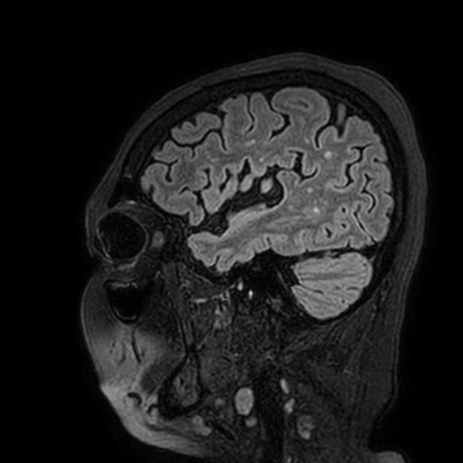 Cavernous hemangioma of the cerebellar falx (Radiopaedia 73025-83724 Sagittal FLAIR 39).jpg