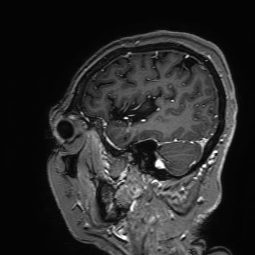 Cavernous hemangioma of the cerebellar falx (Radiopaedia 73025-83724 Sagittal T1 C+ 168).jpg