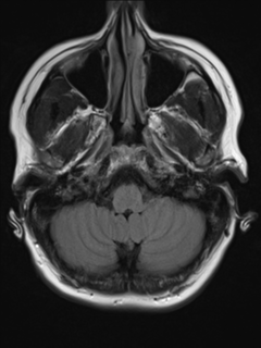 File:Cavernous malformation (cavernous angioma or cavernoma) (Radiopaedia 36675-38237 Axial T2 FLAIR 3).png