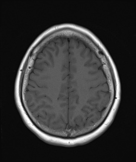 File:Cavernous sinus meningioma (Radiopaedia 63682-72367 Axial T1 17).jpg