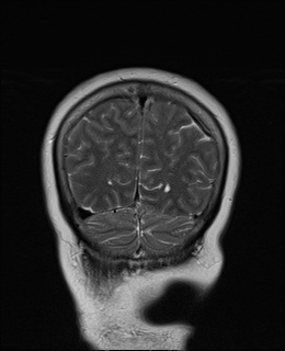 File:Cavernous sinus meningioma (Radiopaedia 63682-72367 Coronal T2 19).jpg