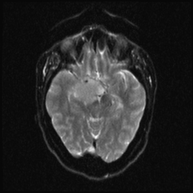 Cavernous sinus meningioma (Radiopaedia 63682-72367 DWI 10).jpg
