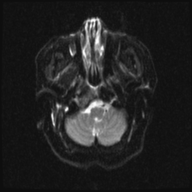 File:Cavernous sinus meningioma (Radiopaedia 63682-72367 DWI 4).jpg