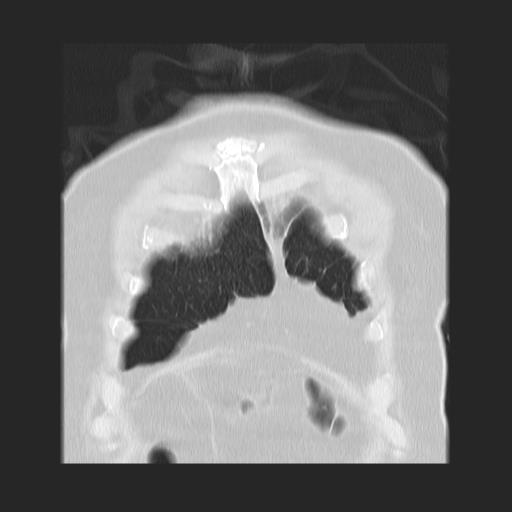File:Cavitating pulmonary metastases (Radiopaedia 89545-106544 Coronal lung window 5).jpg