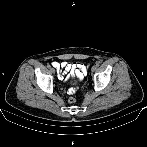 Cecal adenocarcinoma (Radiopaedia 85324-100916 Axial non-contrast 88).jpg