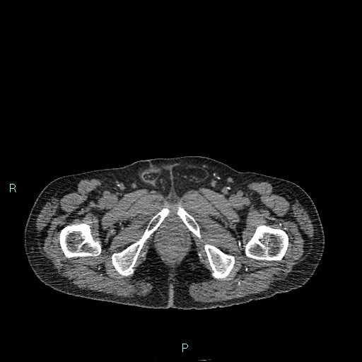 Cecal bascule (Radiopaedia 85770-101586 Axial non-contrast 112).jpg
