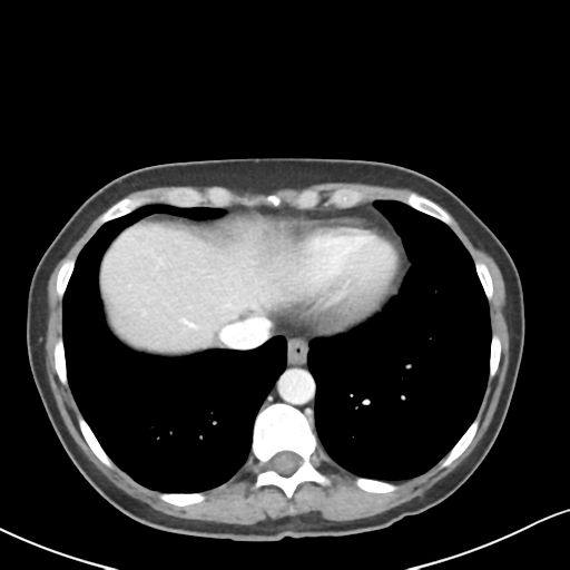 Cecal internal hernia through the foramen of Winslow (Radiopaedia 44820-48651 B 6).png