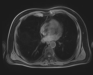 Cecal mass causing appendicitis (Radiopaedia 59207-66532 Axial T1 7).jpg
