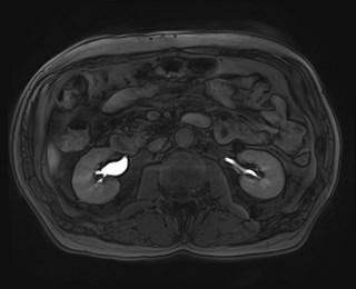 File:Cecal mass causing appendicitis (Radiopaedia 59207-66532 K 62).jpg