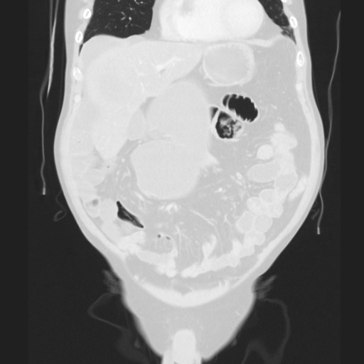 Cecal volvulus (Radiopaedia 75378-86620 Coronal lung window 53).jpg