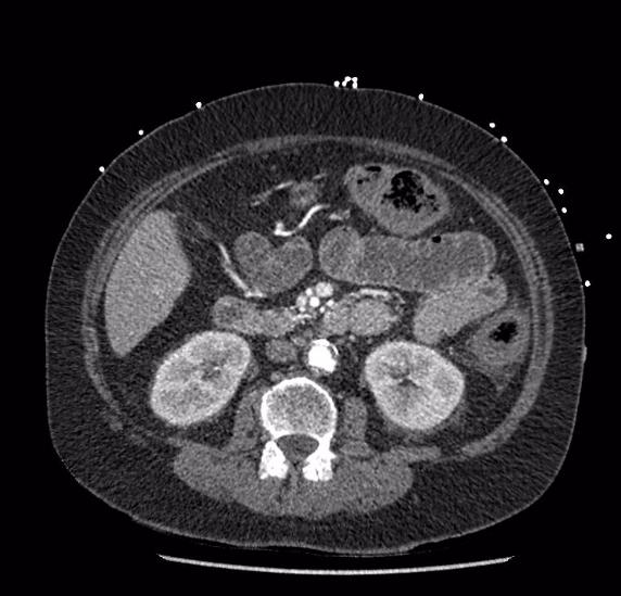 Celiac artery severe stenosis and dissection (Radiopaedia 44128-47842 B 42).jpg