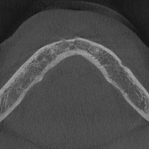 Cemento-osseous dysplasia (Radiopaedia 48251-53126 Axial non-contrast 12).jpg