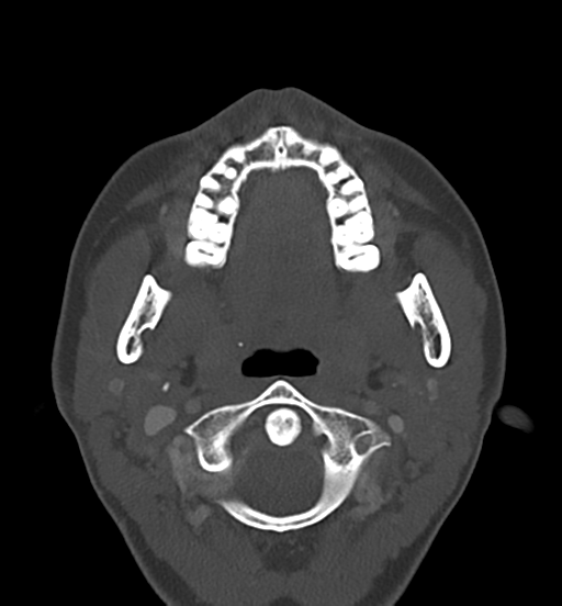 Cemento-ossifying fibroma (Radiopaedia 46243-50643 Axial bone window 34).png