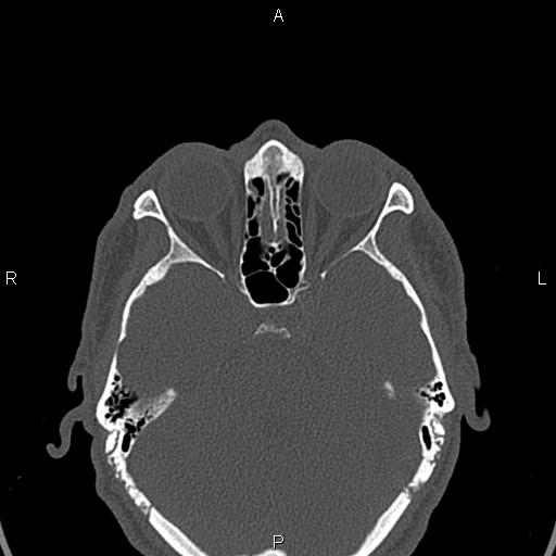File:Central giant cell granuloma (Radiopaedia 83346-97761 Axial bone window 59).jpg