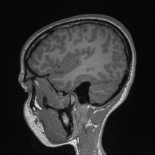 Central neurocytoma (Radiopaedia 37664-39557 Sagittal T1 23).png