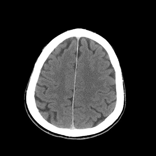 Central neurocytoma (Radiopaedia 68725-78432 Axial C+ 73).jpg