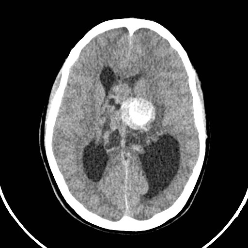 Central neurocytoma (Radiopaedia 84497-99871 Axial non-contrast 27).jpg